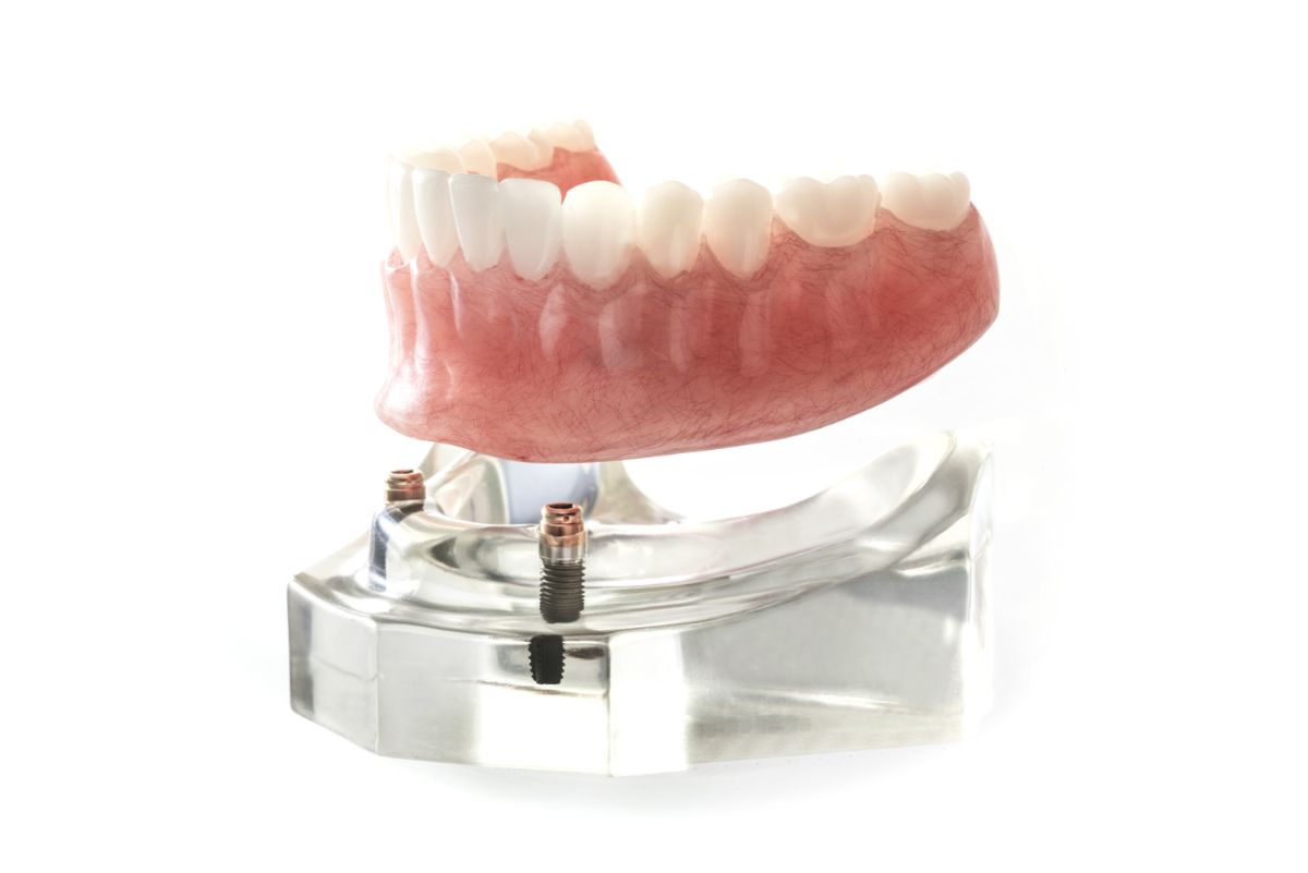 Everything You Need To Know About All-in-4 Dental Implants